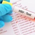 Test Herpes pada kelamin