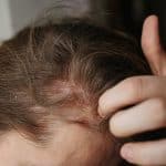 psoriasis kulit kepala