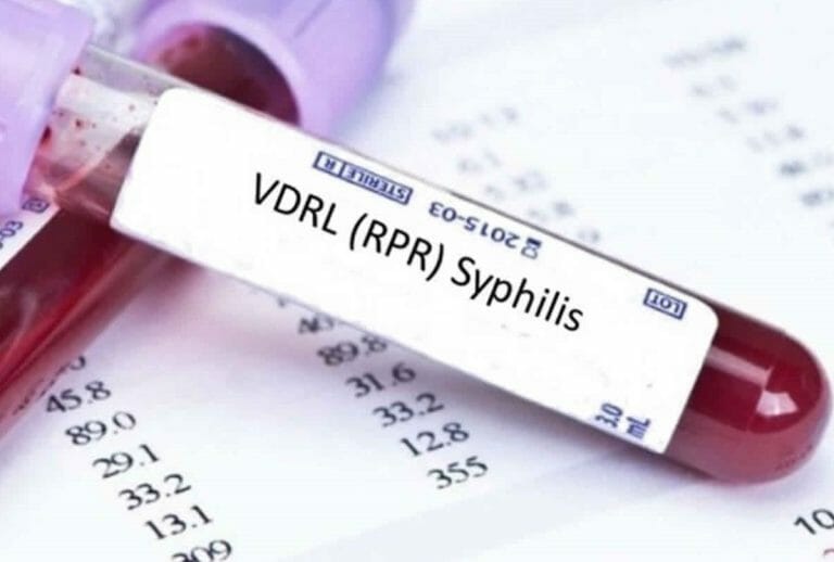 Pemeriksaan Laboratorium Sifilis