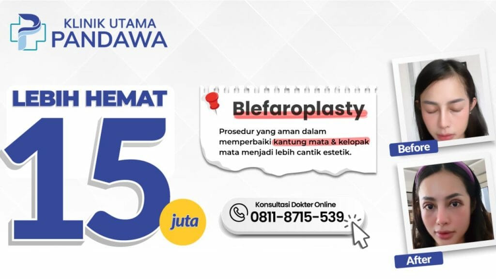 Blepharoplasty Before After Promo Operasi Kelopak Mata Di Klinik Utama Pandawa Jakarta 1 1024x576