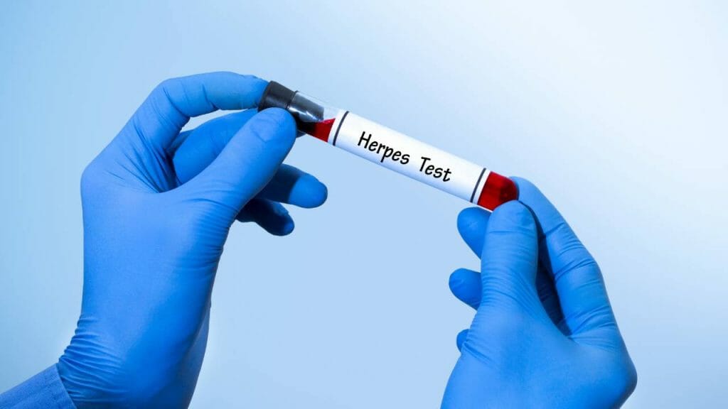 Diagnosis Herpes Genital Herpes Simplex 1024x576