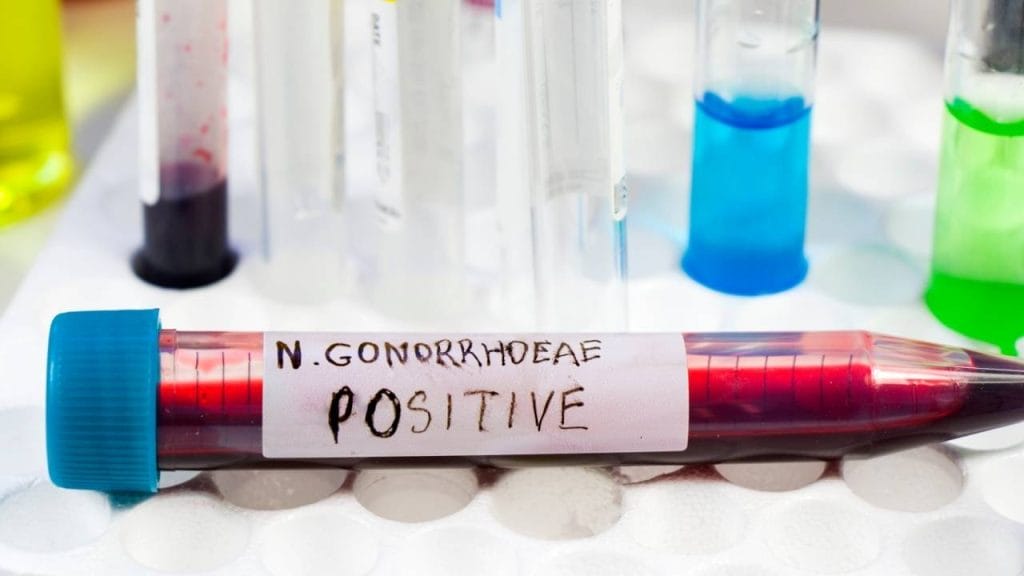 Pemeriksaan Untuk Mendeteksi Gonore Di Laboratorium 1024x576